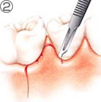 歯肉の切開