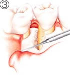 歯肉の剥離