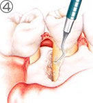 歯根表面の清掃