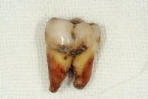 重度の歯周病の歯