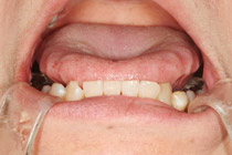 舌の歯の跡